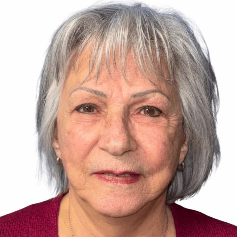 Après — patiente traitée pour une blépharoplastie complète