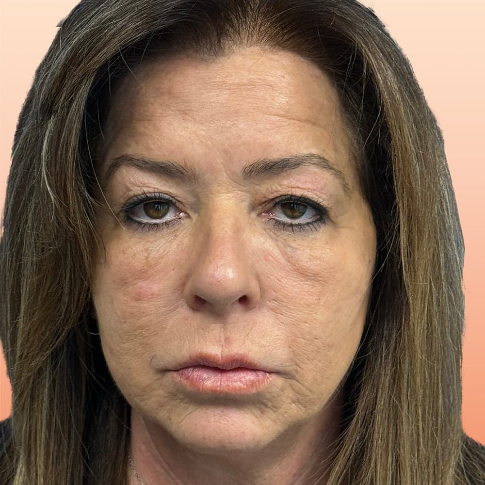 Avant — patiente traitée pour une blépharoplastie inférieure